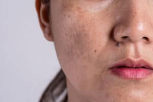 how to even out uneven skin tone